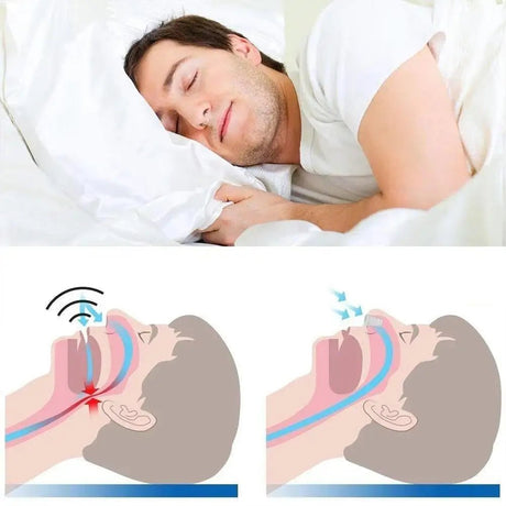 Adjustable Comfortable Anti - Snoring Mouth Guard Appliance - eelhoe - Sleep Galleria
